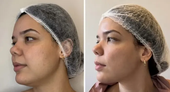 Resultado antes e depois — protocolo facial