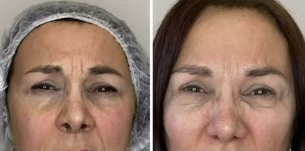 Resultado antes e depois — protocolo facial