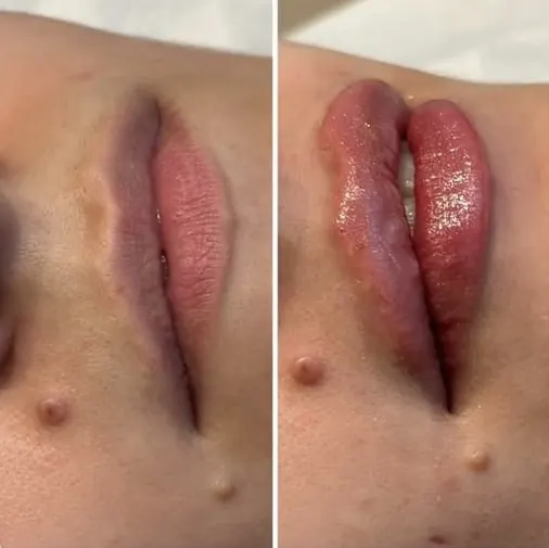 Resultado antes e depois — procedimento labial