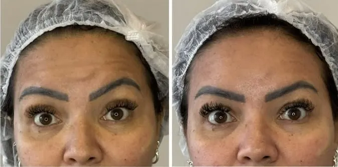Resultado antes e depois — olhar
